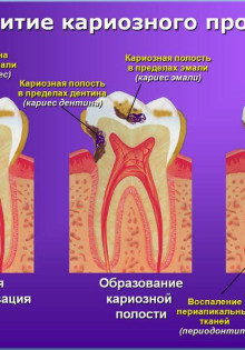 Лечение пульпита и профилактика