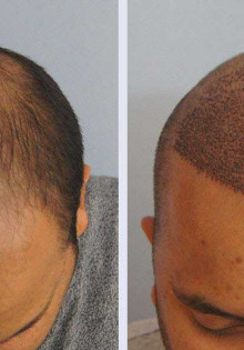 Пересадка волос современными методами