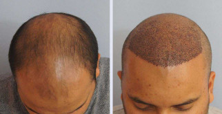 Пересадка волос современными методами