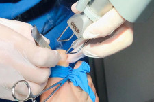 Безболезненное лазерное удаление вросшего ногтя