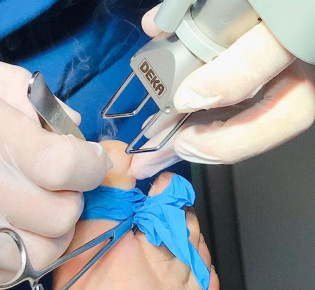 Безболезненное лазерное удаление вросшего ногтя