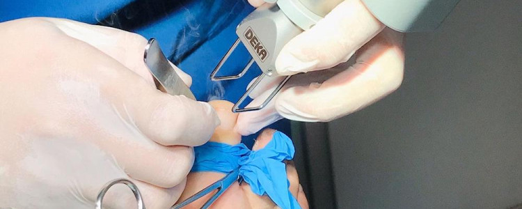 Безболезненное лазерное удаление вросшего ногтя