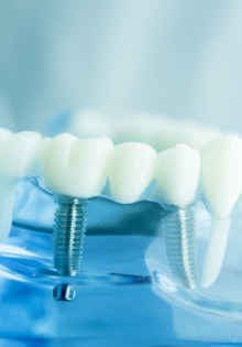 Как выполняется имплантация зубов в клинике экспертной косметологии?