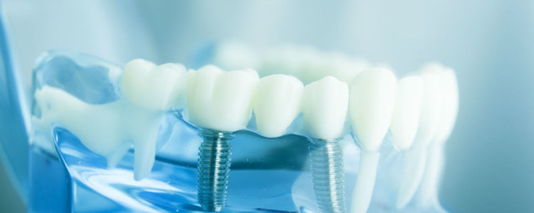 Как выполняется имплантация зубов в клинике экспертной косметологии?