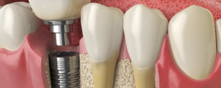 Коронка на зуб: когда необходима и от чего зависит выбор конструкции