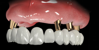 Какая разница между базальной имплантацией и обычной?