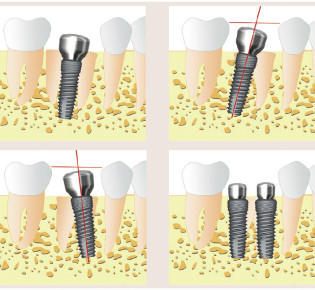 Имплантация зубов: революция в стоматологии