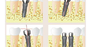 Имплантация зубов: революция в стоматологии