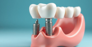 Зубные импланты: новый взгляд на улыбку и здоровье