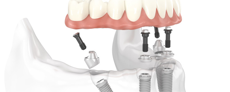 Суть методики All on 4 имплантации зубов