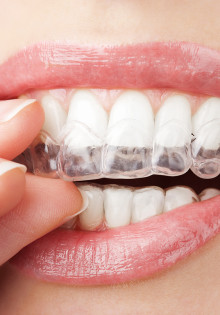 Как работают элайнеры для выравнивания зубов?