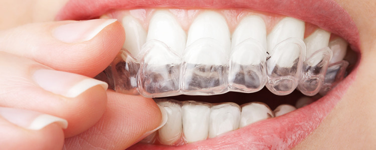 Как работают элайнеры для выравнивания зубов?