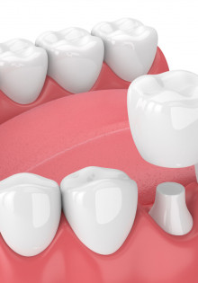 Коронки на зубы: качественная установка, гарантия, доступные цены