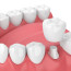 Коронки на зубы: качественная установка, гарантия, доступные цены