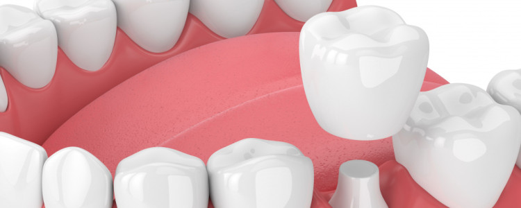 Коронки на зубы: качественная установка, гарантия, доступные цены