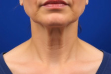 Эффективный способ устранения дряблости кожи шеи