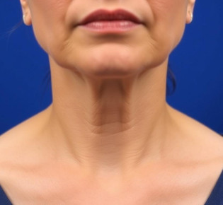 Эффективный способ устранения дряблости кожи шеи