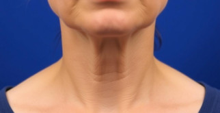 Эффективный способ устранения дряблости кожи шеи