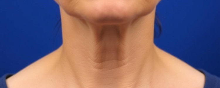 Эффективный способ устранения дряблости кожи шеи