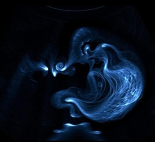 Тромбоэластография в акушерстве: контроль гемостаза во время беременности и родов