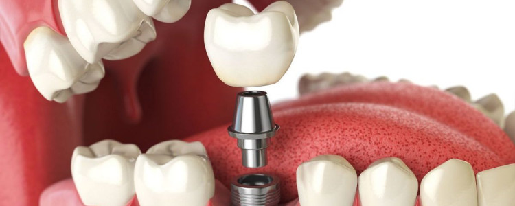 В каких случаях необходимо протезирование зубов?