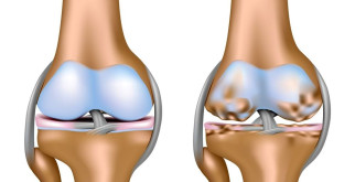 Эффективные методы лечения остеоартроза: как вернуть радость движения
