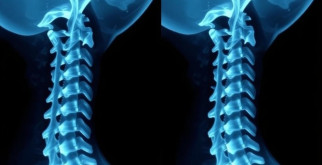 Рентген шейного отдела позвоночника