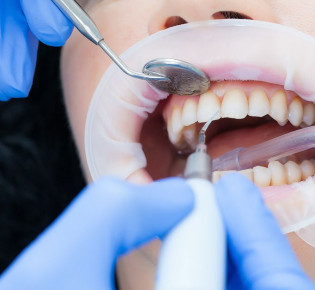 Ультразвуковая чистка зубов: Преимущества и возможные ограничения