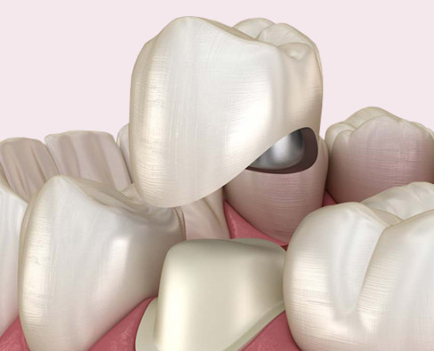 Металлокерамические коронки: особенности