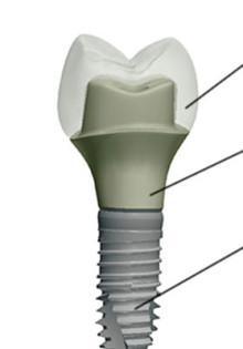 Удобные и эстетичные решения: абатменты для имплантов