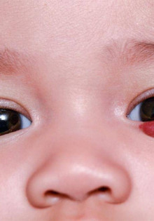 Сосудистая ангиома