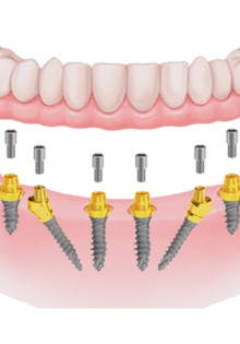 Что такое протезирование на 6 имплантатах?