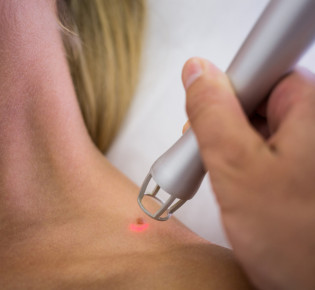 Почему папилломы требуют внимания