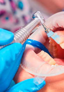 Плюсы профессиональной гигиены в стоматологии
