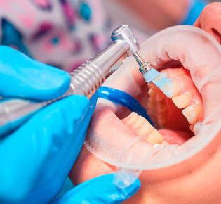 Плюсы профессиональной гигиены в стоматологии