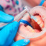Плюсы профессиональной гигиены в стоматологии