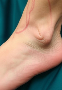 Как избежать осложнений при хронической венозной недостаточности